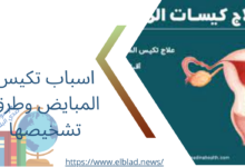 اسباب تكيس المبايض وطرق تشخيصها