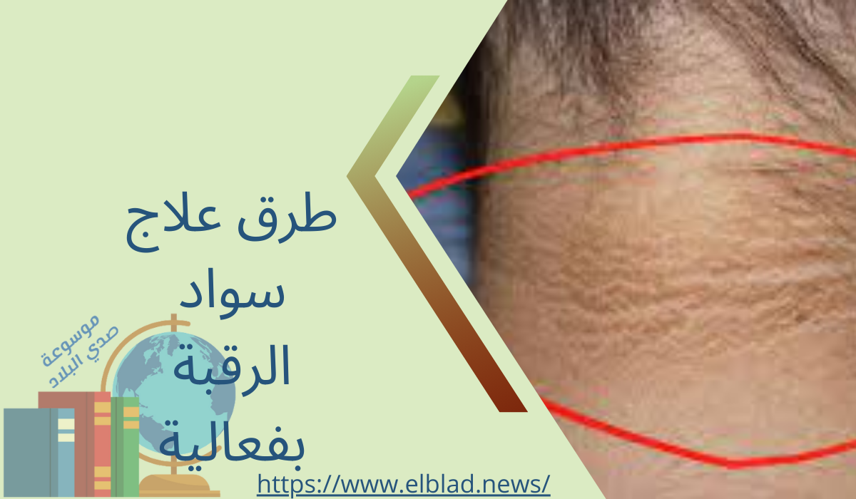 طرق علاج سواد الرقبة بفعالية